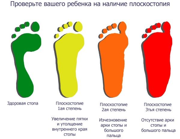 Детское плоскостопие?